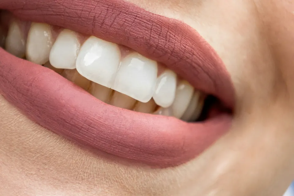 Close-up of a bright, natural-looking smile after cosmetic dental treatment