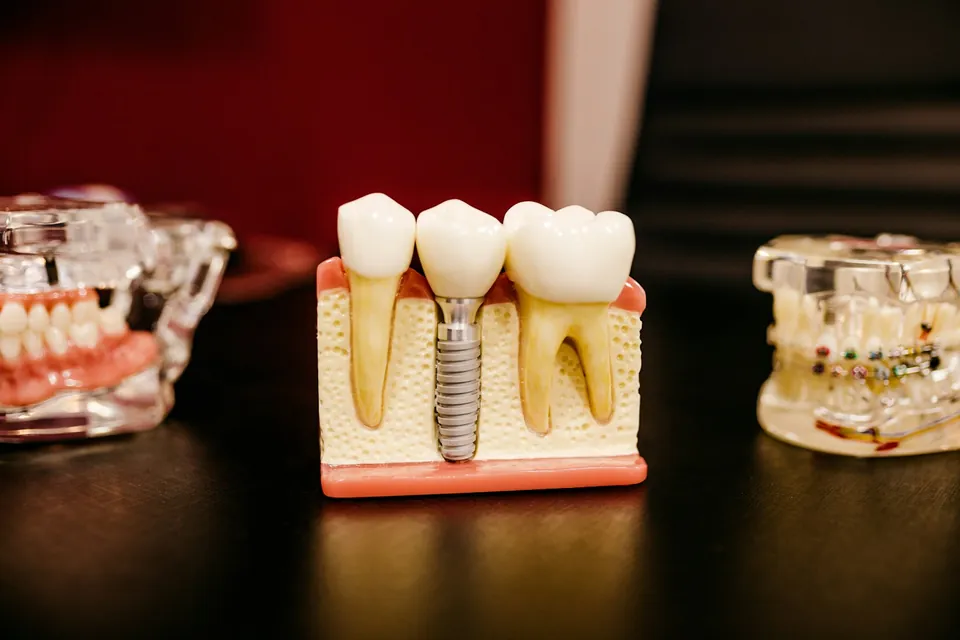 Cross-section model of a dental implant seated in the jawbone beside natural teeth