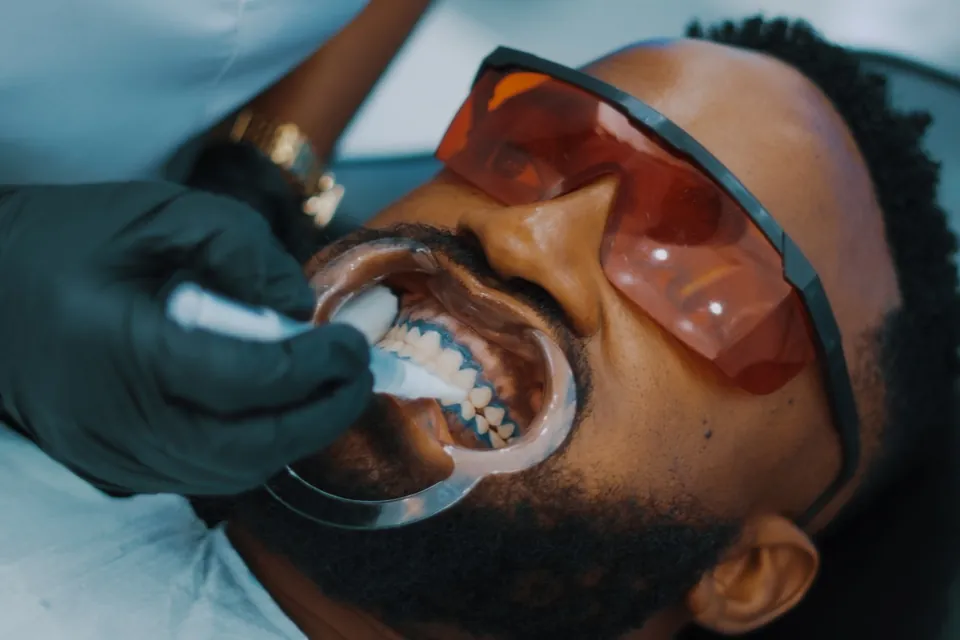 In-office teeth whitening gel being applied with the lips retracted and protective eyewear on